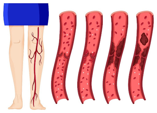 O que pode causar trombose na perna? 