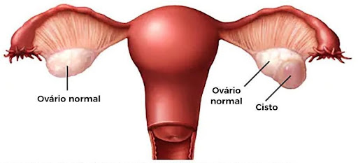 Cistos ovarianos e síndrome do ovário policístico (SOP) 